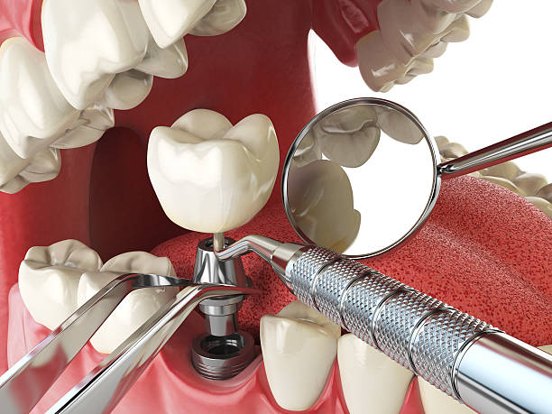 Best Knocked-Out Tooth Emergency  in Charter Oak, CA